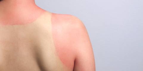 a shirtless person with a terrible sunburn