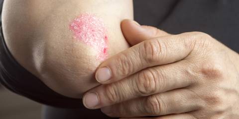 someone rubbing and scratching psoriasis on the elbow