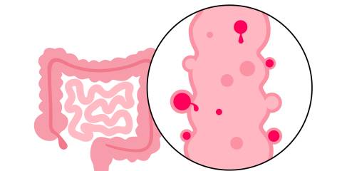 an illustration of a large intestine with inflammation and bleeding