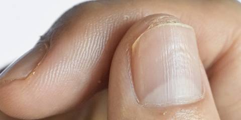 a close-up of fingernails with pitting and ridges
